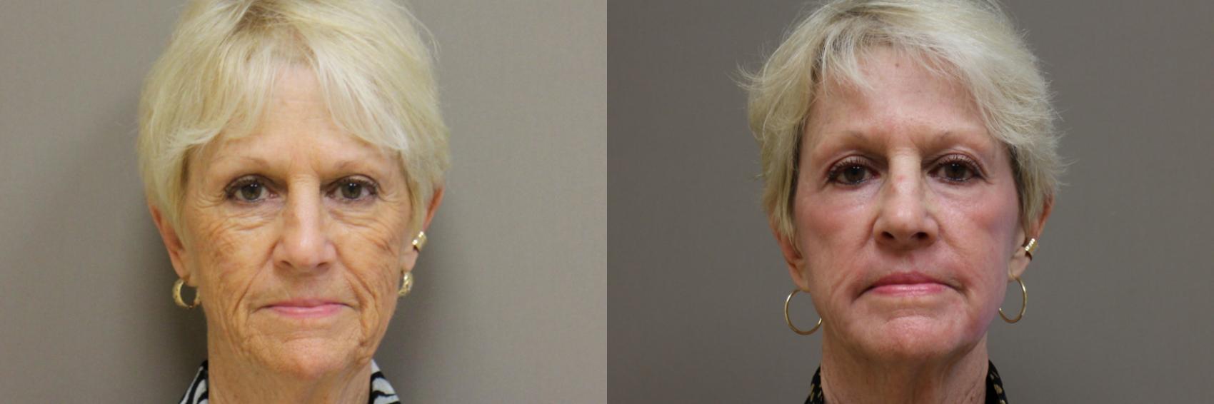 Lasers & Lights Case 176 Before & After View #1 | Webster, TX | Houston Plastic and Reconstructive Surgery