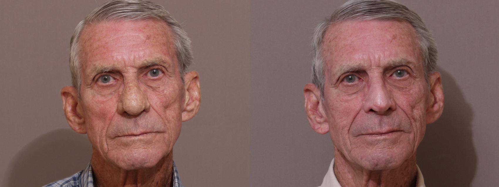 Lasers & Lights Case 177 Before & After View #1 | Webster, TX | Houston Plastic and Reconstructive Surgery