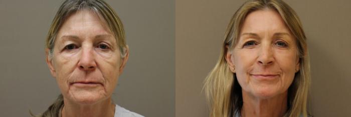Lasers & Lights Case 178 Before & After View #1 | Webster, TX | Houston Plastic and Reconstructive Surgery