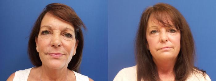 Lasers & Lights Case 216 Before & After View #1 | Webster, TX | Houston Plastic and Reconstructive Surgery