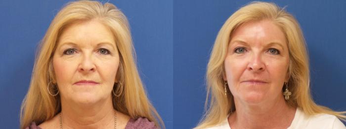 Lasers & Lights Case 263 Before & After View #1 | Webster, TX | Houston Plastic and Reconstructive Surgery
