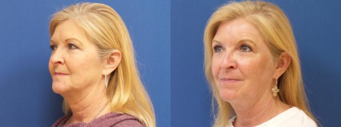 Lasers & Lights Case 263 Before & After View #2 | Webster, TX | Houston Plastic and Reconstructive Surgery