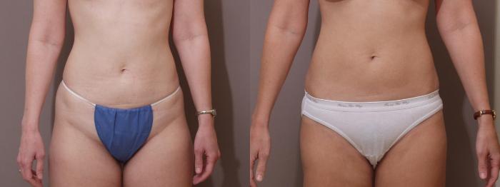 Liposuction Case 109 Before & After View #1 | Webster, TX | Houston Plastic and Reconstructive Surgery