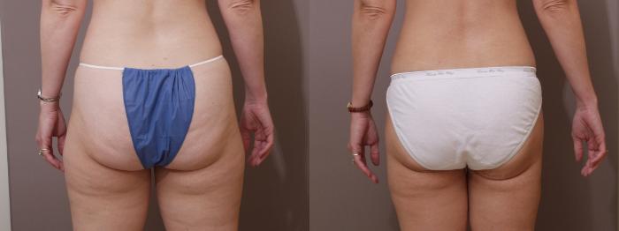 Liposuction Case 109 Before & After View #2 | Webster, TX | Houston Plastic and Reconstructive Surgery