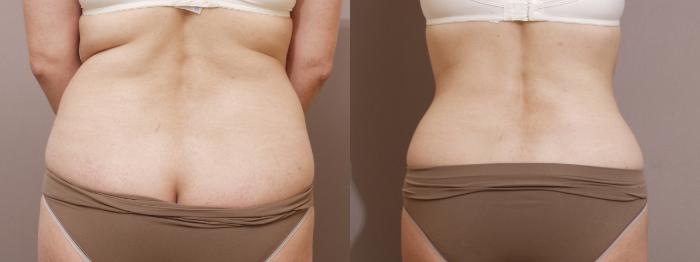 Liposuction Case 127 Before & After View #1 | Webster, TX | Houston Plastic and Reconstructive Surgery