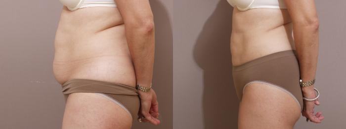 Liposuction Case 127 Before & After View #2 | Webster, TX | Houston Plastic and Reconstructive Surgery