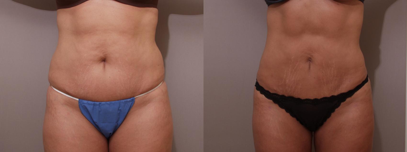 Liposuction Case 15 Before & After View #1 | Webster, TX | Houston Plastic and Reconstructive Surgery