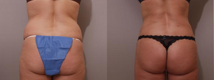 Liposuction Case 15 Before & After View #2 | Webster, TX | Houston Plastic and Reconstructive Surgery