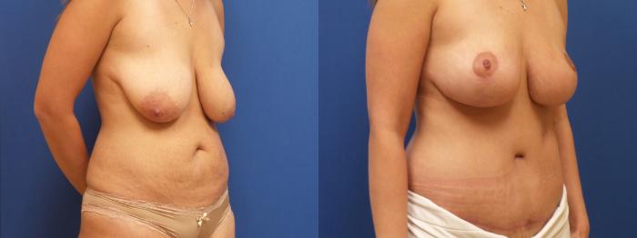 Liposuction Case 232 Before & After View #1 | Webster, TX | Houston Plastic and Reconstructive Surgery