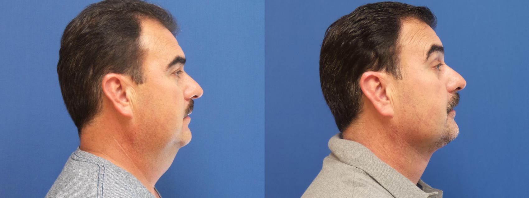 Liposuction Case 235 Before & After View #1 | Webster, TX | Houston Plastic and Reconstructive Surgery
