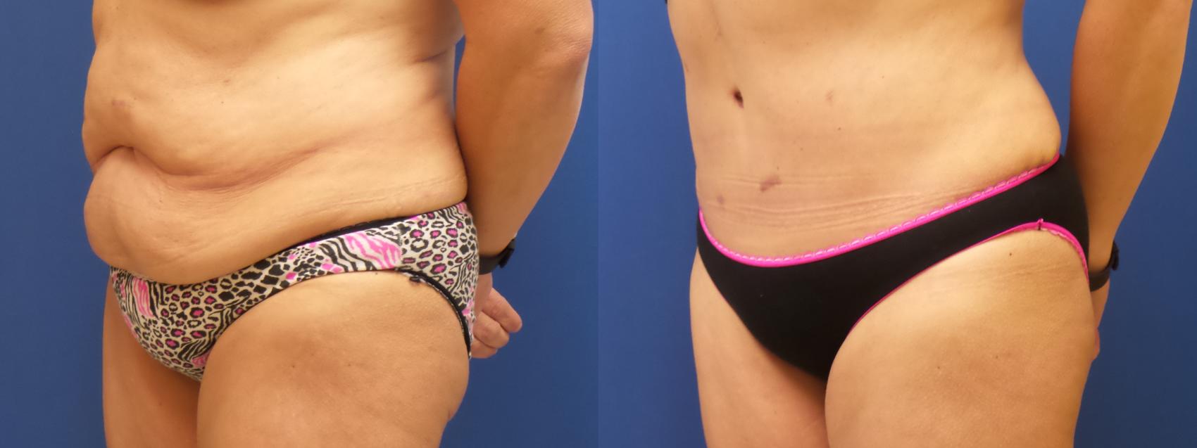 Liposuction Case 236 Before & After View #1 | Webster, TX | Houston Plastic and Reconstructive Surgery