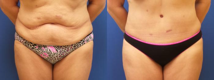 Liposuction Case 236 Before & After View #2 | Webster, TX | Houston Plastic and Reconstructive Surgery