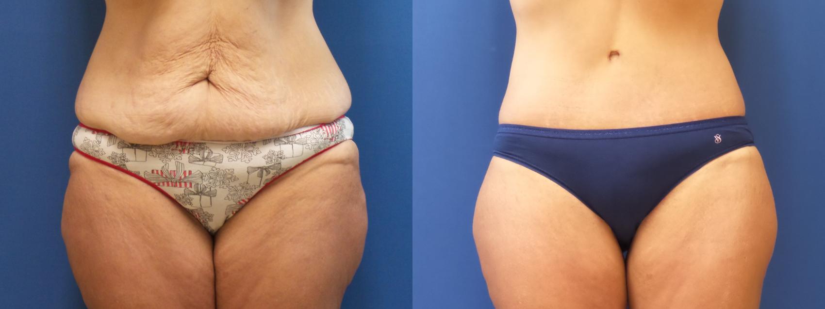 Liposuction Case 237 Before & After View #1 | Webster, TX | Houston Plastic and Reconstructive Surgery