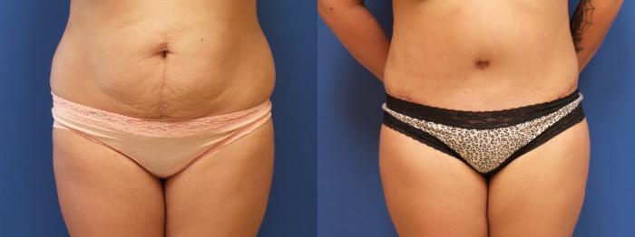 Liposuction Case 238 Before & After View #1 | Webster, TX | Houston Plastic and Reconstructive Surgery