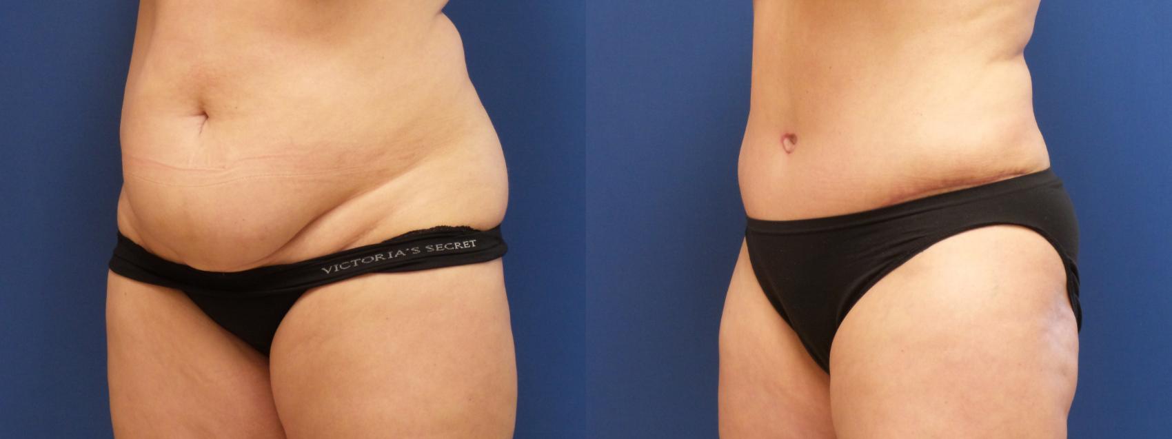 Liposuction Case 239 Before & After View #1 | Webster, TX | Houston Plastic and Reconstructive Surgery