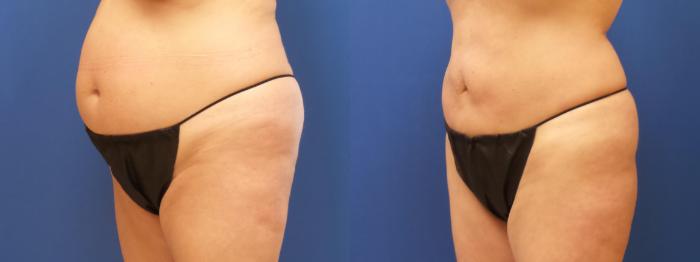 Liposuction Case 277 Before & After View #1 | Webster, TX | Houston Plastic and Reconstructive Surgery