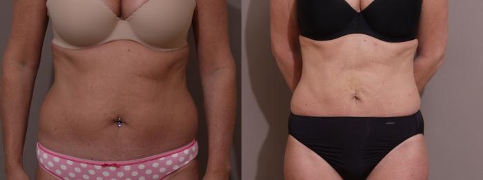 Liposuction Case 55 Before & After View #1 | Webster, TX | Houston Plastic and Reconstructive Surgery