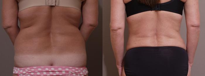 Liposuction Case 55 Before & After View #2 | Webster, TX | Houston Plastic and Reconstructive Surgery