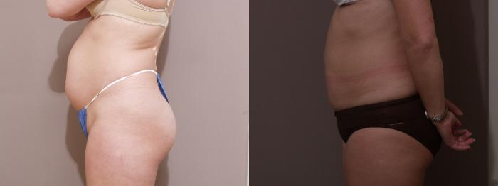 Liposuction Case 85 Before & After View #2 | Webster, TX | Houston Plastic and Reconstructive Surgery