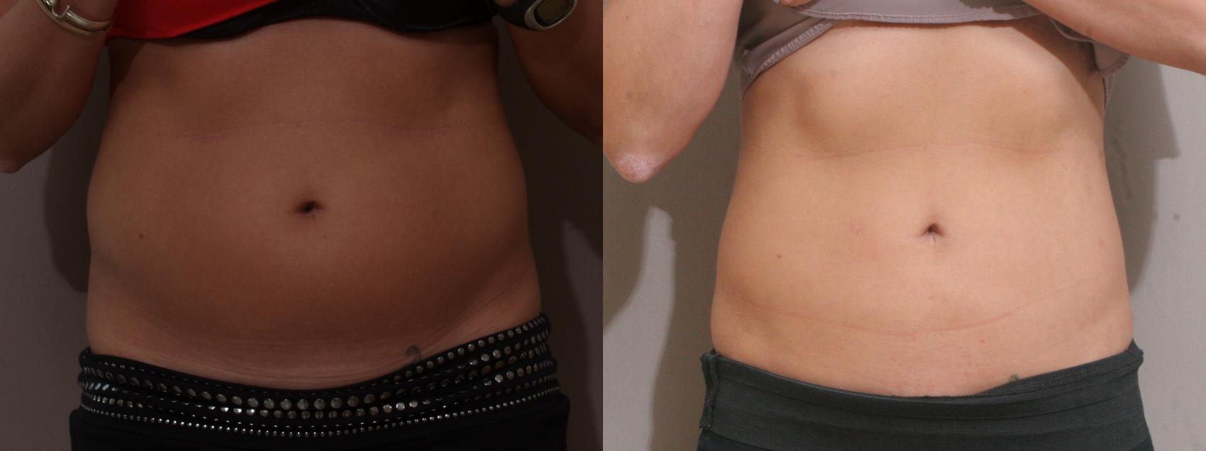 Liposuction Case 97 Before & After View #1 | Webster, TX | Houston Plastic and Reconstructive Surgery