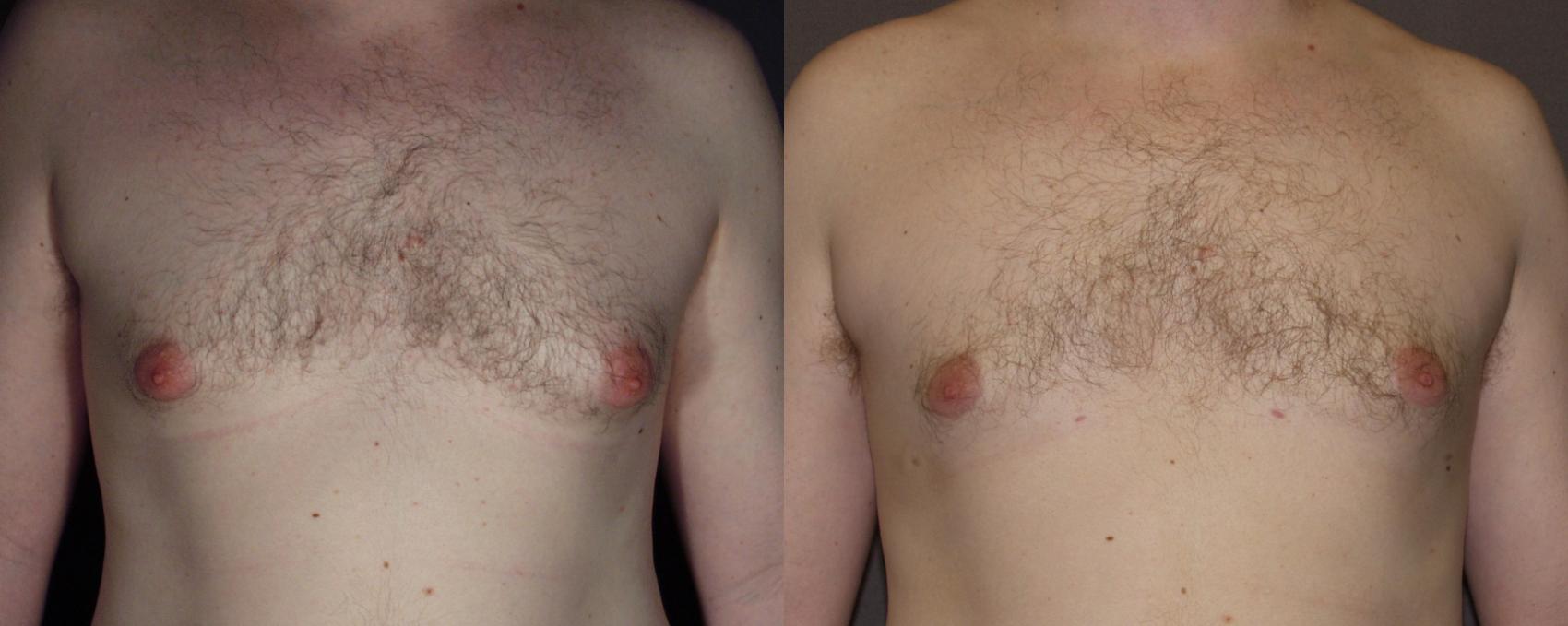 Male Breast Reduction Case 116 Before & After View #1 | Webster, TX | Houston Plastic and Reconstructive Surgery