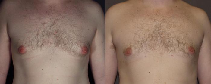Male Breast Reduction Case 116 Before & After View #1 | Webster, TX | Houston Plastic and Reconstructive Surgery