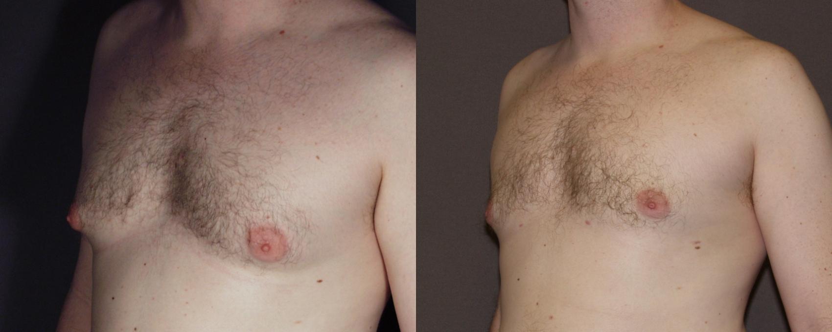 Male Breast Reduction Case 116 Before & After View #2 | Webster, TX | Houston Plastic and Reconstructive Surgery