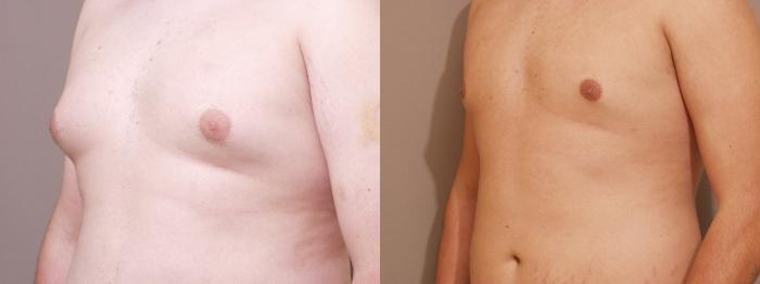 Male Breast Reduction Case 136 Before & After View #1 | Webster, TX | Houston Plastic and Reconstructive Surgery