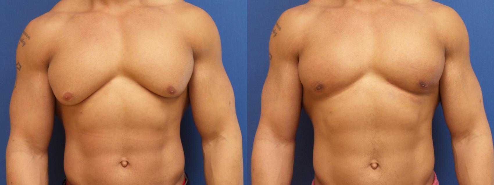 Male Breast Reduction Case 189 Before & After View #1 | Webster, TX | Houston Plastic and Reconstructive Surgery