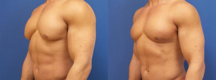 Male Breast Reduction Case 189 Before & After View #2 | Webster, TX | Houston Plastic and Reconstructive Surgery