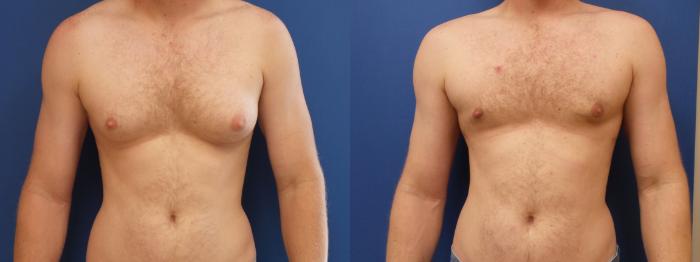 Male Breast Reduction Case 190 Before & After View #1 | Webster, TX | Houston Plastic and Reconstructive Surgery
