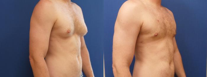 Male Breast Reduction Case 190 Before & After View #2 | Webster, TX | Houston Plastic and Reconstructive Surgery