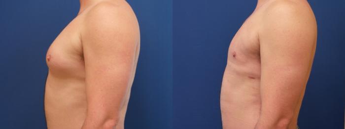 Male Breast Reduction Case 191 Before & After View #2 | Webster, TX | Houston Plastic and Reconstructive Surgery