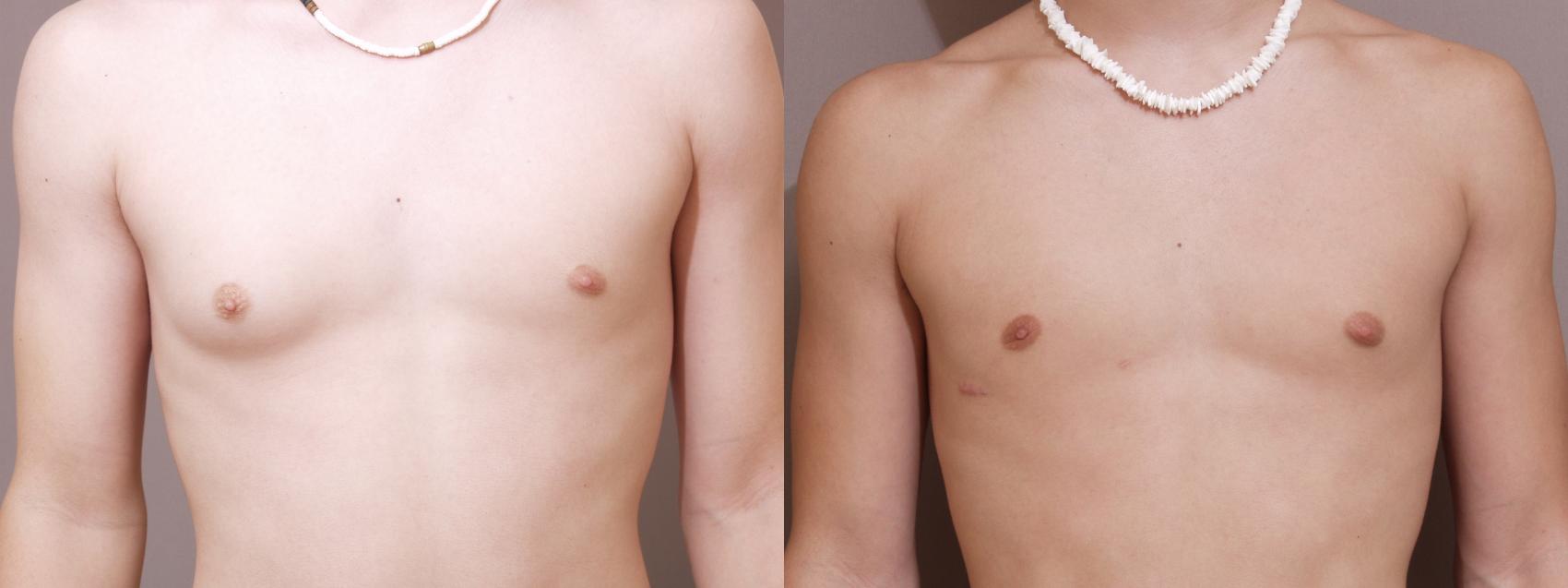 ratio rumor clarity Male Breast Reduction Before & After Photo Gallery | Webster, TX | Houston  Plastic and Reconstructive Surgery