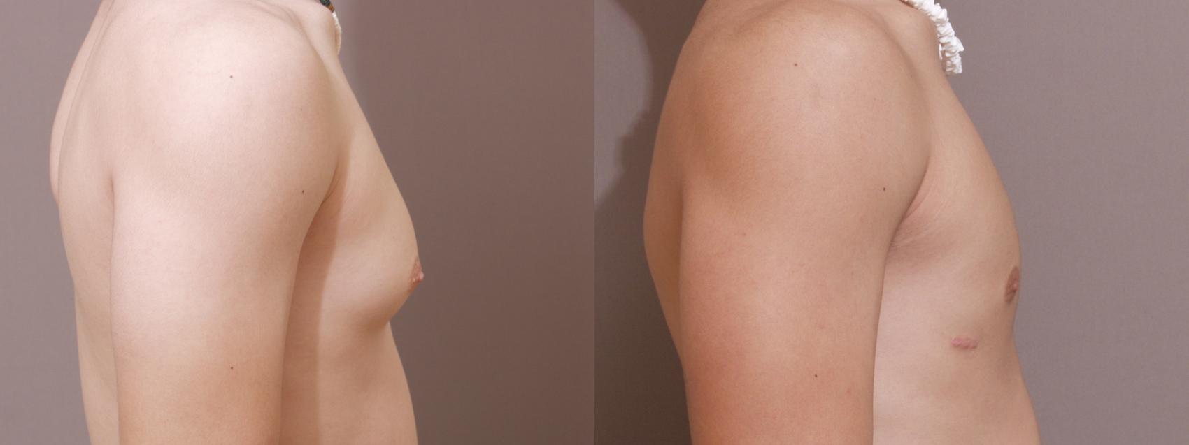 Male Breast Reduction Case 75 Before & After View #2 | Webster, TX | Houston Plastic and Reconstructive Surgery