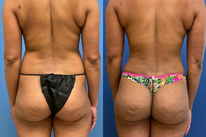 Tummy Tuck Case 286 Before & After Back | Webster, TX | Houston Plastic and Reconstructive Surgery