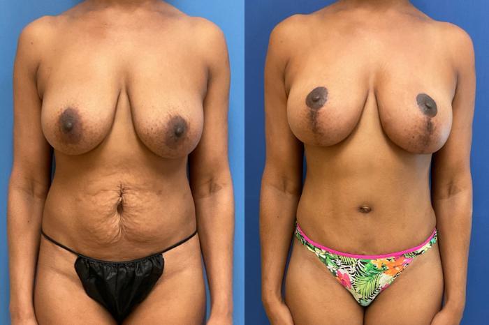 Tummy Tuck Case 286 Before & After Front | Webster, TX | Houston Plastic and Reconstructive Surgery