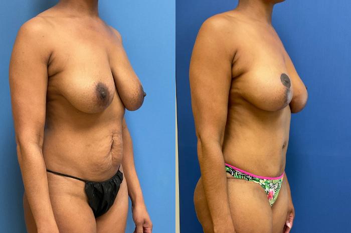 Tummy Tuck Case 286 Before & After Right Oblique | Webster, TX | Houston Plastic and Reconstructive Surgery