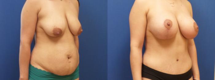 Liposuction Case 294 Before & After Right Oblique | Webster, TX | Houston Plastic and Reconstructive Surgery