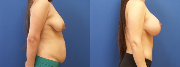 Tummy Tuck Case 294 Before & After Right Side | Webster, TX | Houston Plastic and Reconstructive Surgery