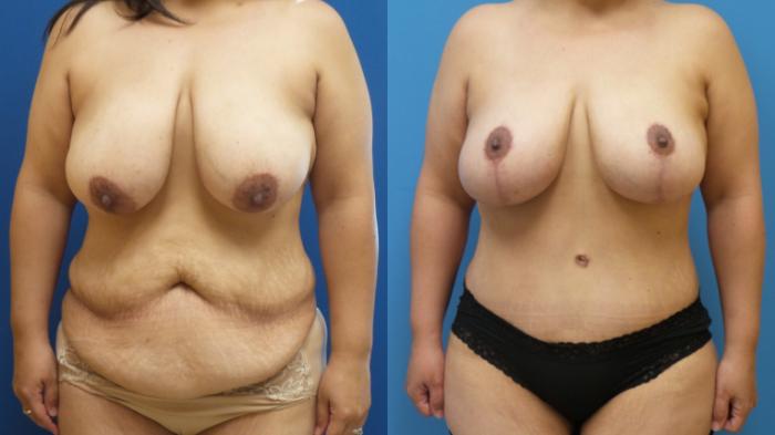 Breast Lift Case 297 Before & After Front | Webster, TX | Houston Plastic and Reconstructive Surgery