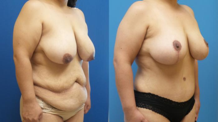 Breast Lift Case 297 Before & After Right Oblique | Webster, TX | Houston Plastic and Reconstructive Surgery
