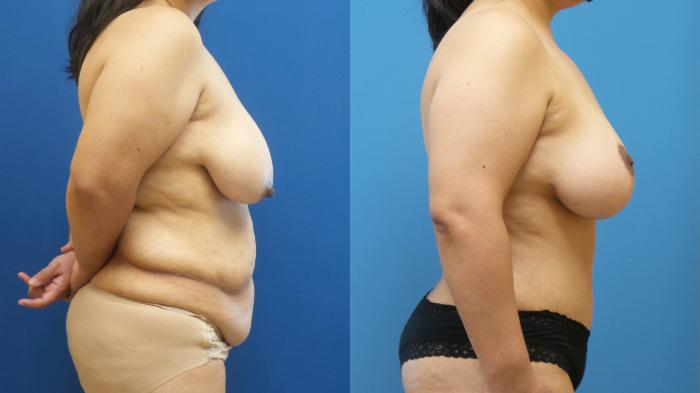 Tummy Tuck Case 297 Before & After Right Side | Webster, TX | Houston Plastic and Reconstructive Surgery