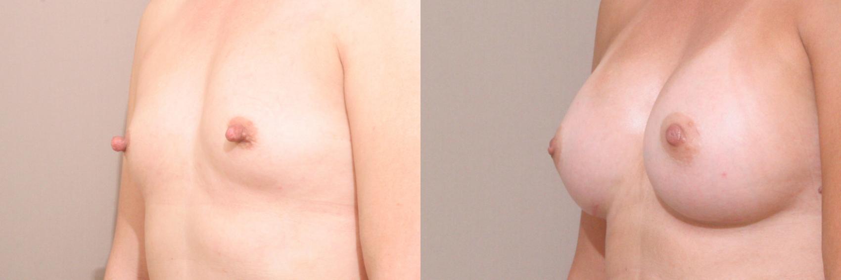Nipple Reduction Case 118 Before & After View #1 | Webster, TX | Houston Plastic and Reconstructive Surgery