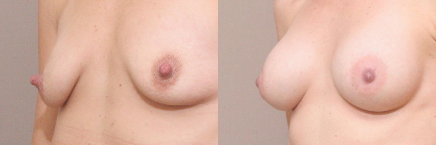 Nipple Reduction Case 132 Before & After View #1 | Webster, TX | Houston Plastic and Reconstructive Surgery