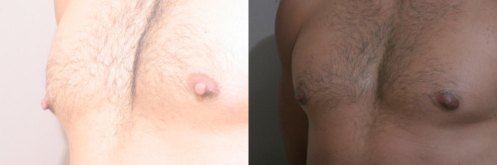 Nipple Reduction Case 135 Before & After View #1 | Webster, TX | Houston Plastic and Reconstructive Surgery