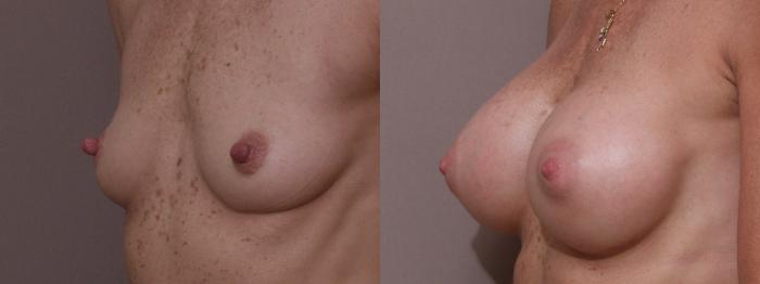 Nipple Reduction Case 26 Before & After View #1 | Webster, TX | Houston Plastic and Reconstructive Surgery