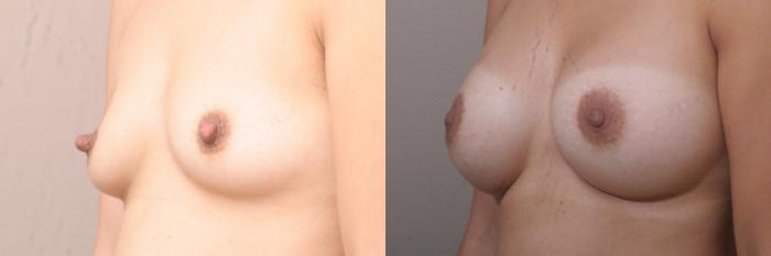 Nipple Reduction Case 27 Before & After View #1 | Webster, TX | Houston Plastic and Reconstructive Surgery