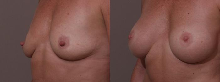 Nipple Reduction Case 61 Before & After View #1 | Webster, TX | Houston Plastic and Reconstructive Surgery