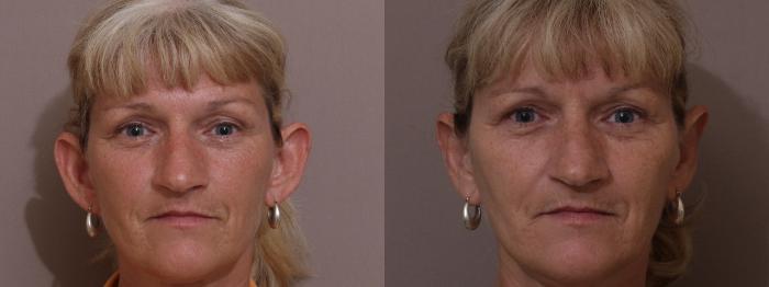 Otoplasty Case 68 Before & After View #1 | Webster, TX | Houston Plastic and Reconstructive Surgery